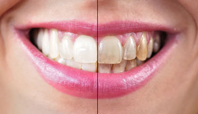 teeth whitening before and after
